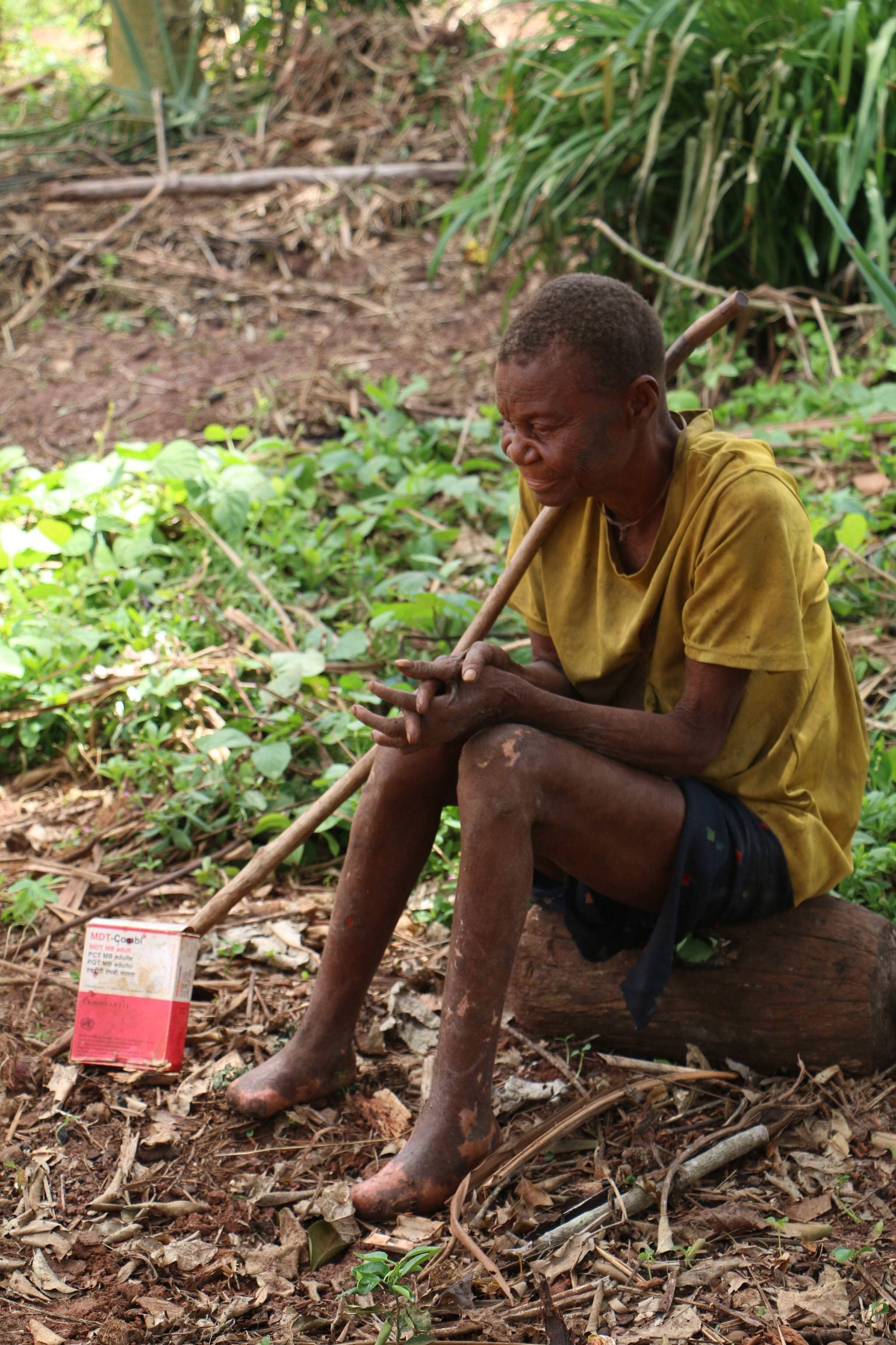 Homme atteint de la lèpre dans la Likouala